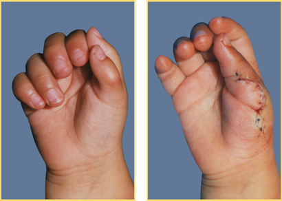 Congentital Hand Surgery