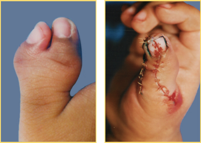 Congentital Hand Surgery
