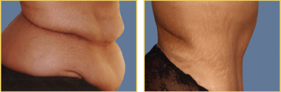 Post-Bariatric Surgery