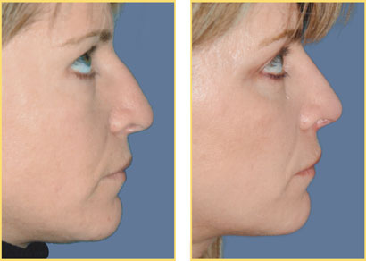 Rhinoplasty - Nose Job