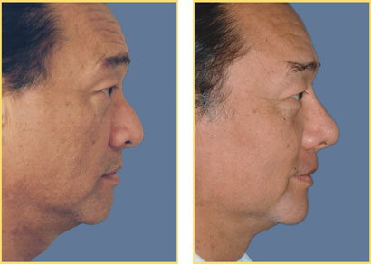 Rhinoplasty