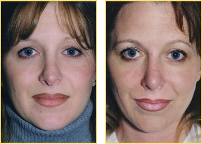 Rhinoplasty - Nose Job