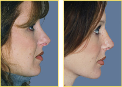 Rhinoplasty - Nose Job