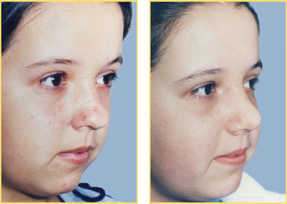 Rhinoplasty - Nose Job