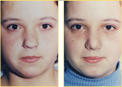 Rhinoplasty - Nose Job
