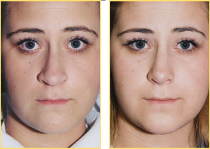 Rhinoplasty - Nose Job