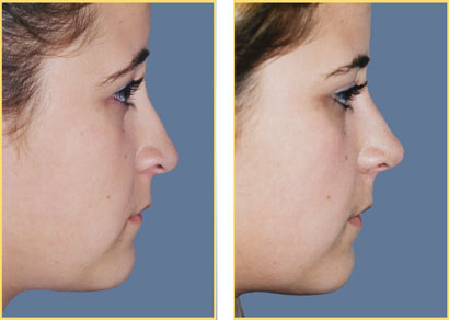 Rhinoplasty - Nose Job
