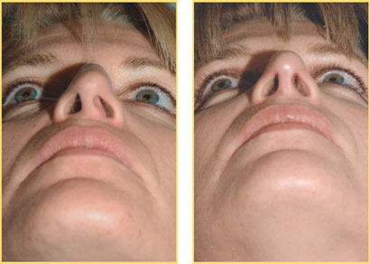 Rhinoplasty - Nose Job