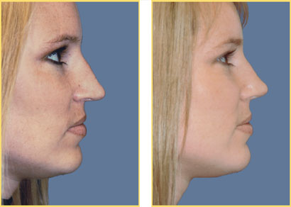 Rhinoplasty - Nose Job