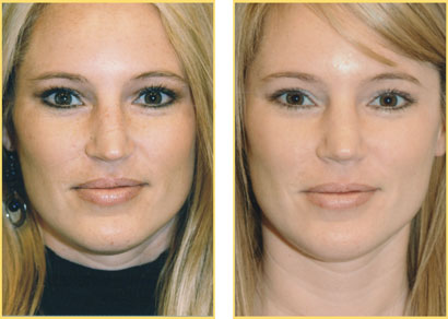 Rhinoplasty - Nose Job