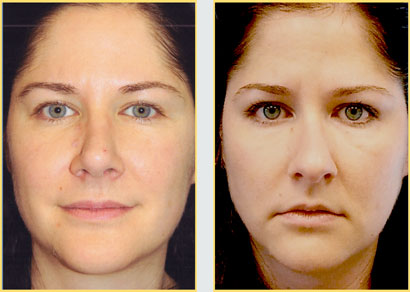 Rhinoplasty - Nose Job