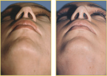 Rhinoplasty - Nose Job