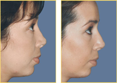Rhinoplasty - Nose Job