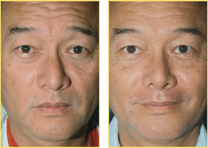 Rhinoplasty - Nose Job