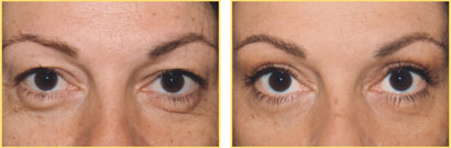 Before and After Eyelid Surgery