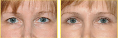Before and After Eyelid Surgery