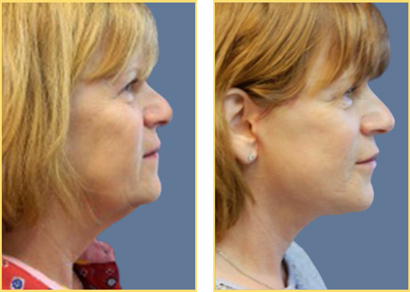 Facelift
