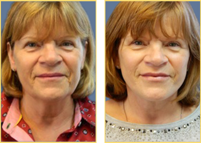 Facelift