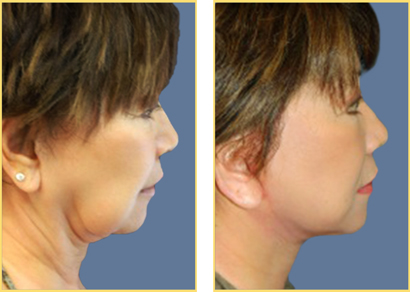Facelift