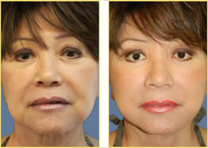 Facelift