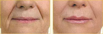 Juvederm Juvederm