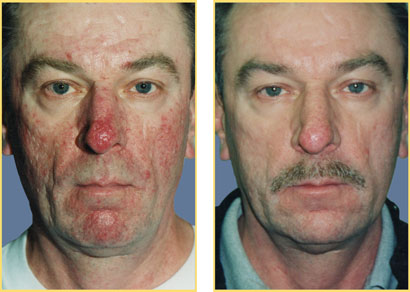 Laser Vessel Reduction