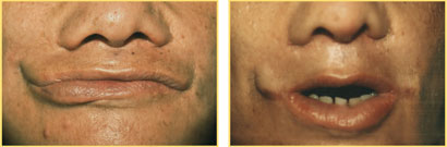Macrostromia Surgery