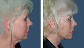 In Office Next Day Facelift