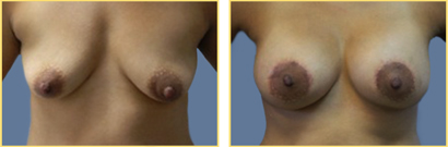 Superior Cresent Mastopexy