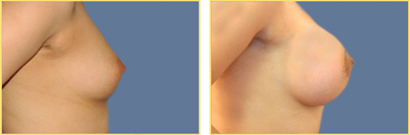 Superior Cresent Mastopexy
