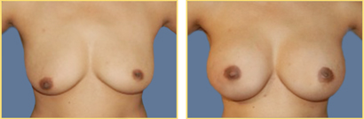 Superior Cresent Mastopexy