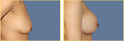 Superior Cresent Mastopexy