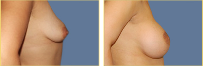 Superior Cresent Mastopexy