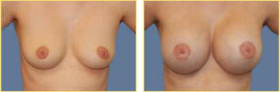 Superior Cresent Mastopexy