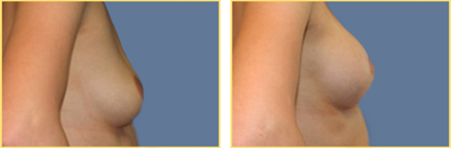 Superior Cresent Mastopexy