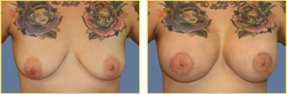 Superior Cresent Mastopexy