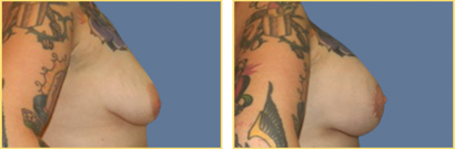 Superior Cresent Mastopexy