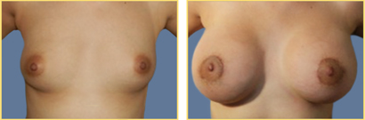 Superior Cresent Mastopexy