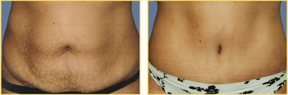 Abdominoplasty (Tummy Tuck)