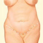 Abdominoplasty - Step 1