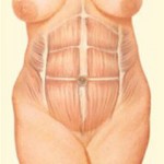 Abdominoplasty - Step 3