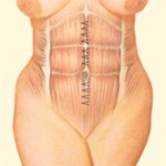 Abdominoplasty - Step 4