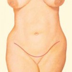 Abdominoplasty - Step 5