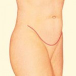 Abdominoplasty - Step 6