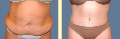 Abdominoplasty