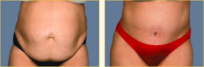 Abdominoplasty (Tummy Tuck)