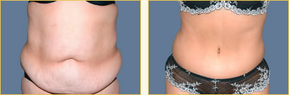 Abdominoplasty