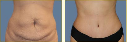 Abdominoplasty (Tummy Tuck)