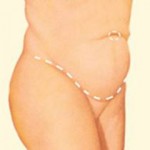 Abdominoplasty - Step 2