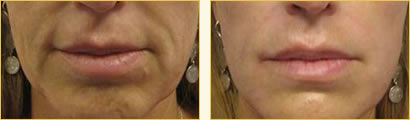 Artefill Wrinkle Reduction